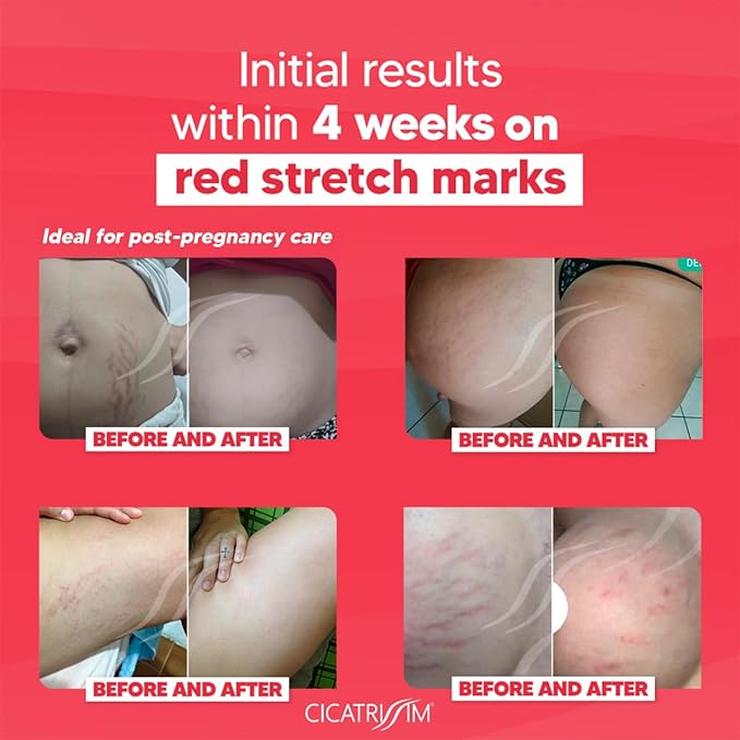 Cicatrissim Red Stretch Mark Cream for Red and Purple Striae - Softens Stretch Marks, Evens Skin Tone, and Firms Skin - All Skin Types - 150g