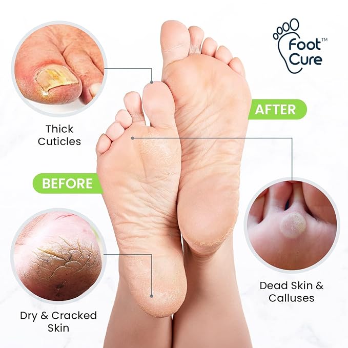 Tea Tree Foot Soak, Callus Remover Gel - Extra Strength Callus Remover Gel & Foot Soak With Epsom Salts For Calluses, Dry Cracked Heels, Toenail Fungus & Odor - Pedicure for Tired Feet